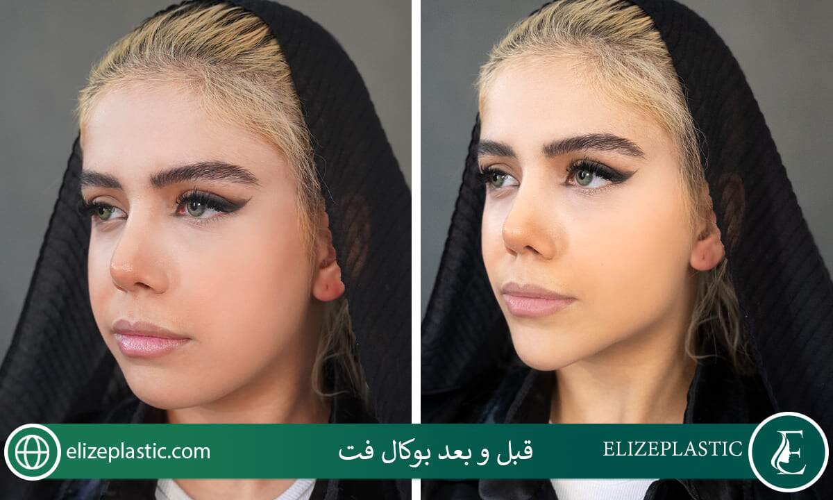 قبل و بعد بوکال فت